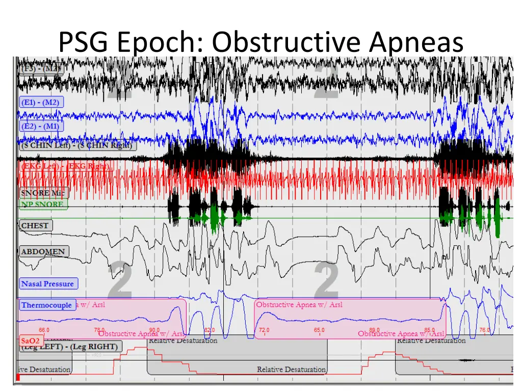 psg epoch obstructive apneas