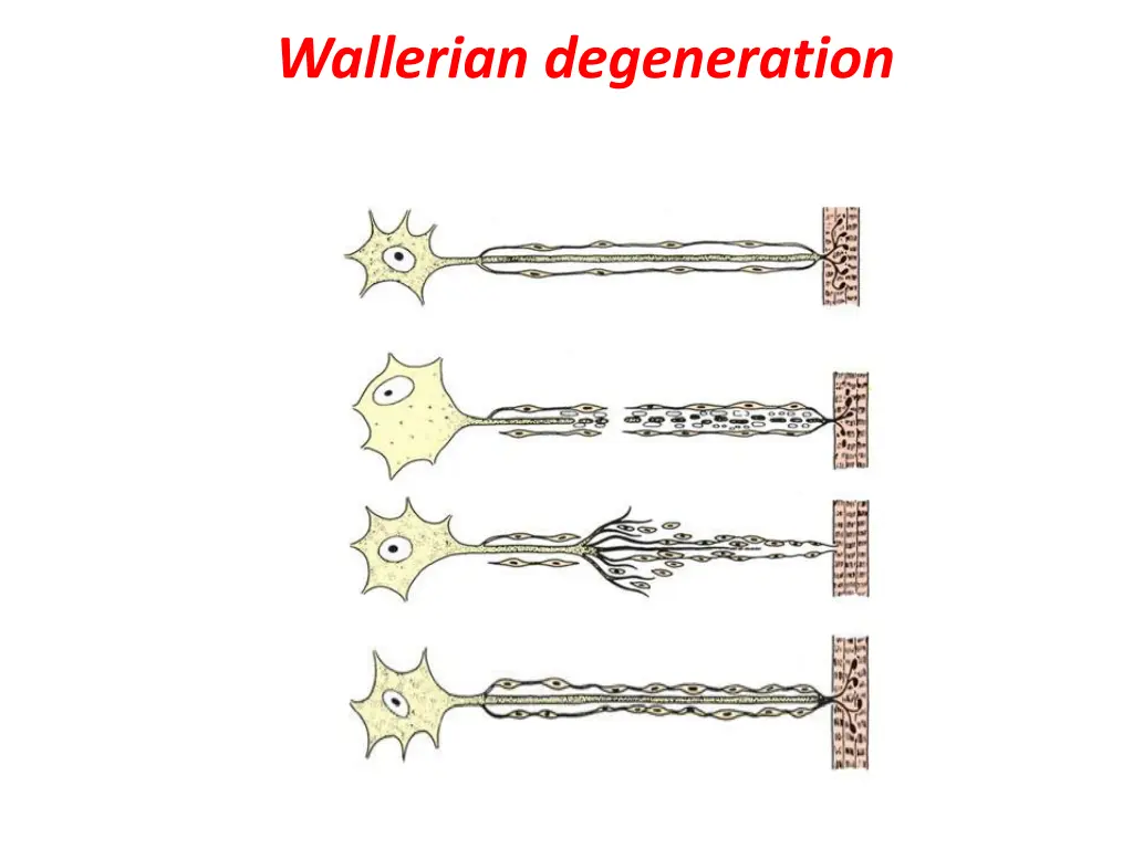 wallerian degeneration