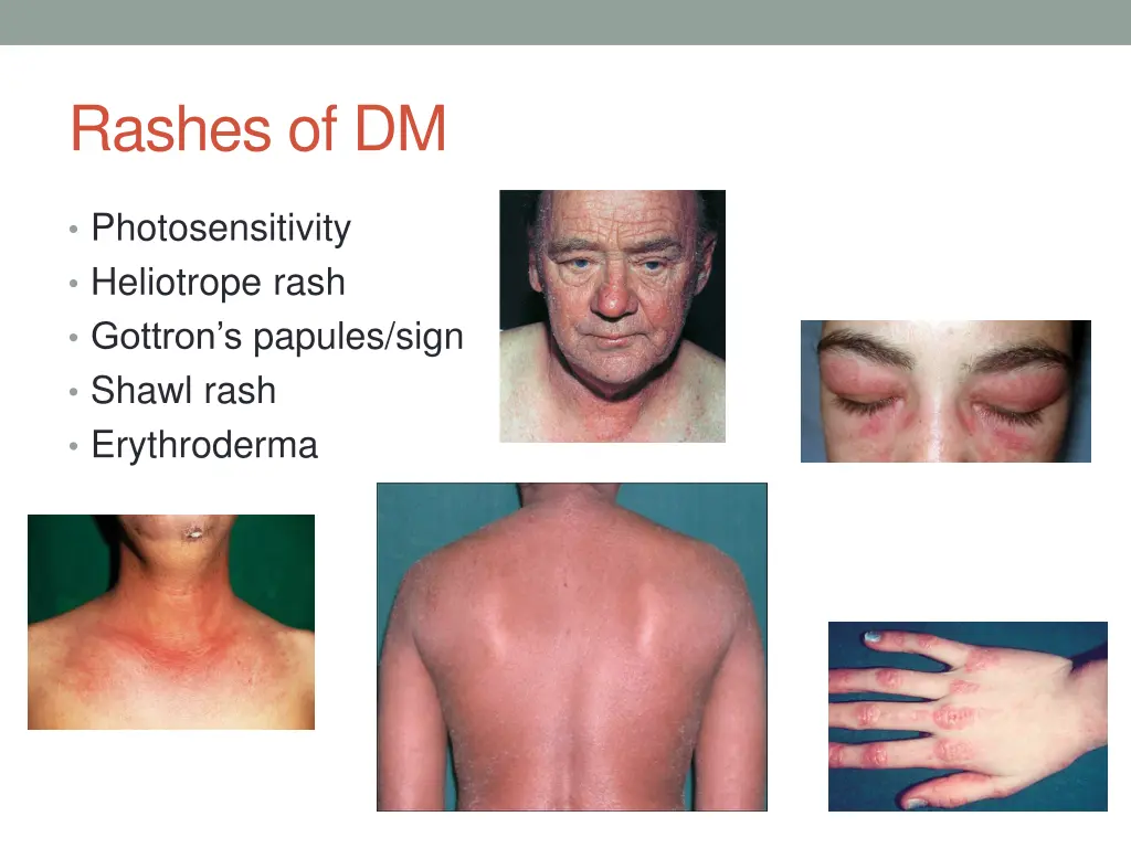rashes of dm