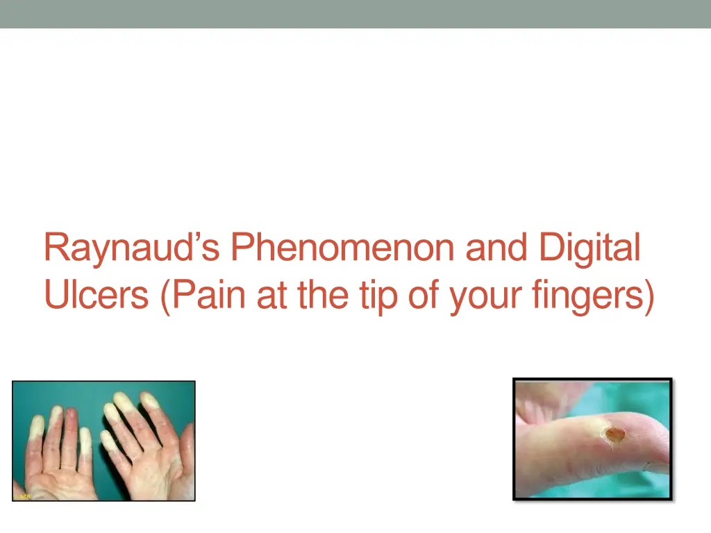raynaud s phenomenon and digital ulcers pain