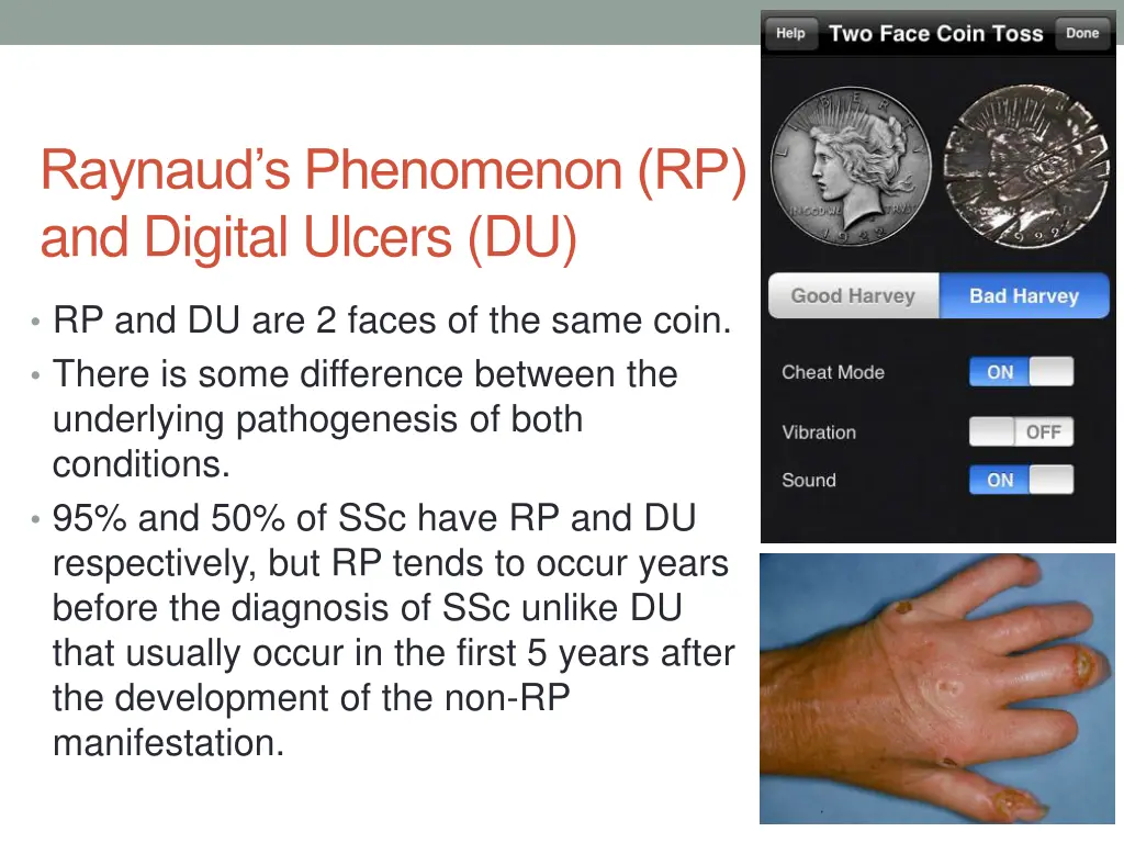 raynaud s phenomenon rp and digital ulcers du