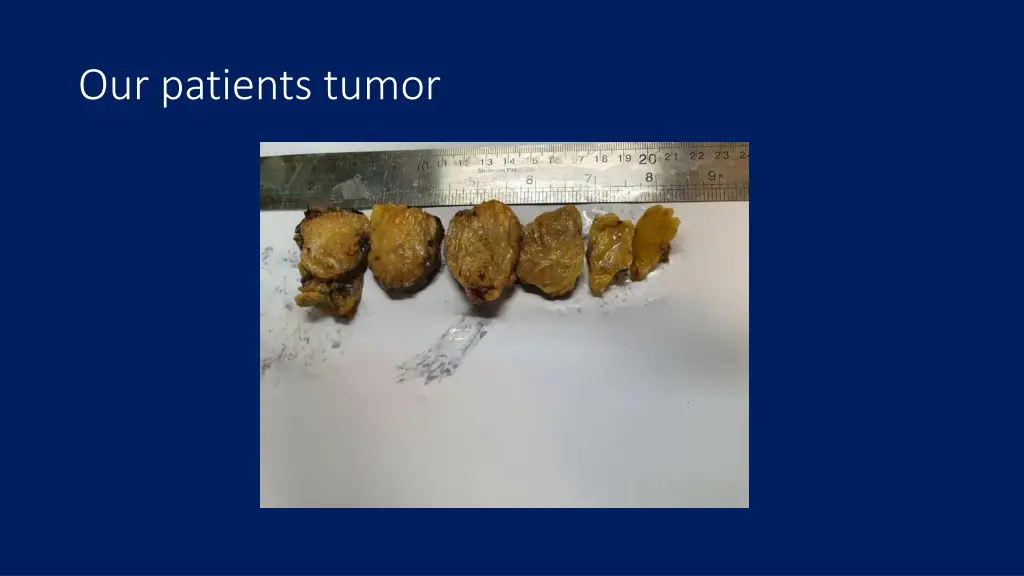 our patients tumor