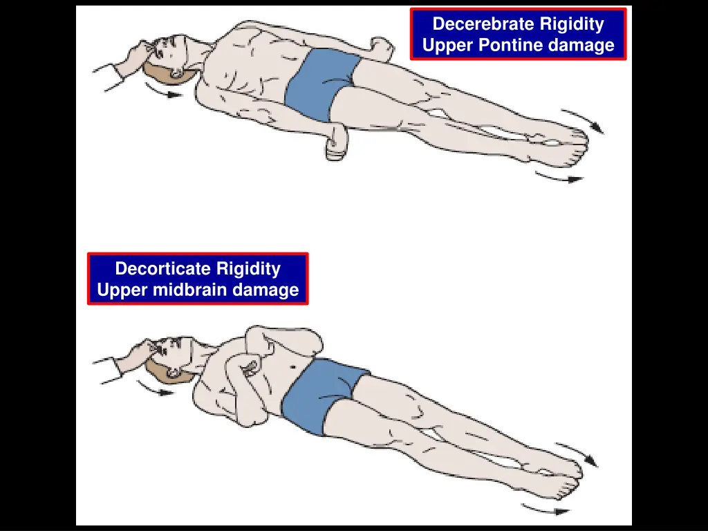 decerebrate rigidity upper pontine damage