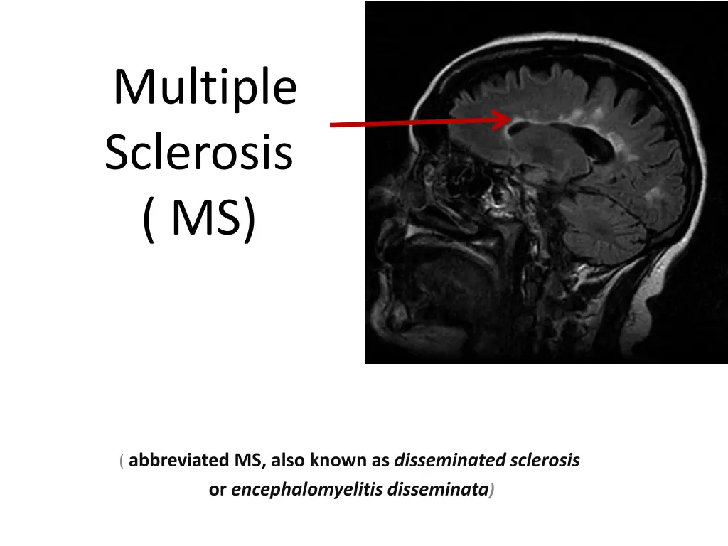 multiple sclerosis ms