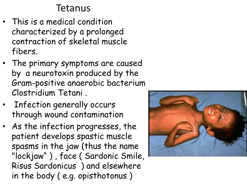 tetanus