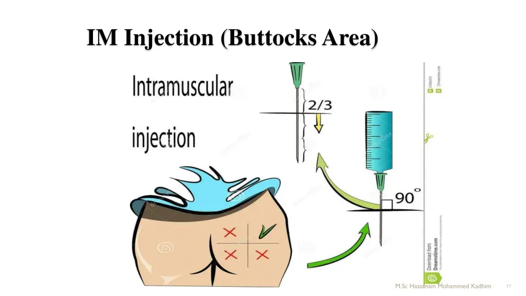 im injection buttocks area