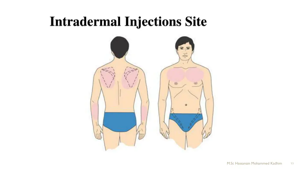 intradermal injections site