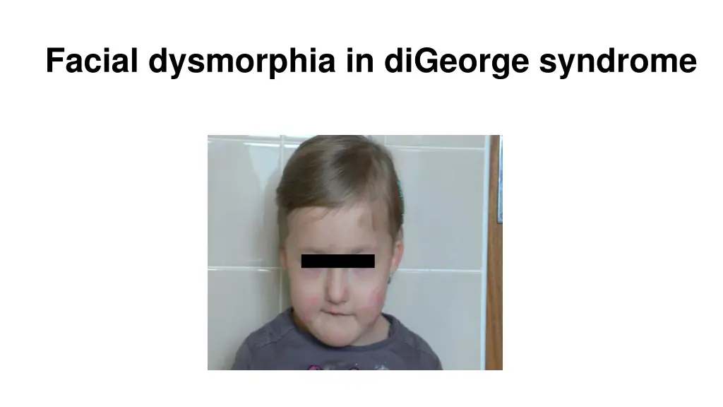 facial dysmorphia in digeorge syndrome