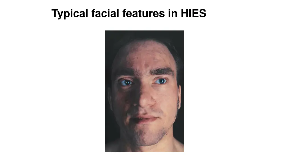 typical facial features in hies