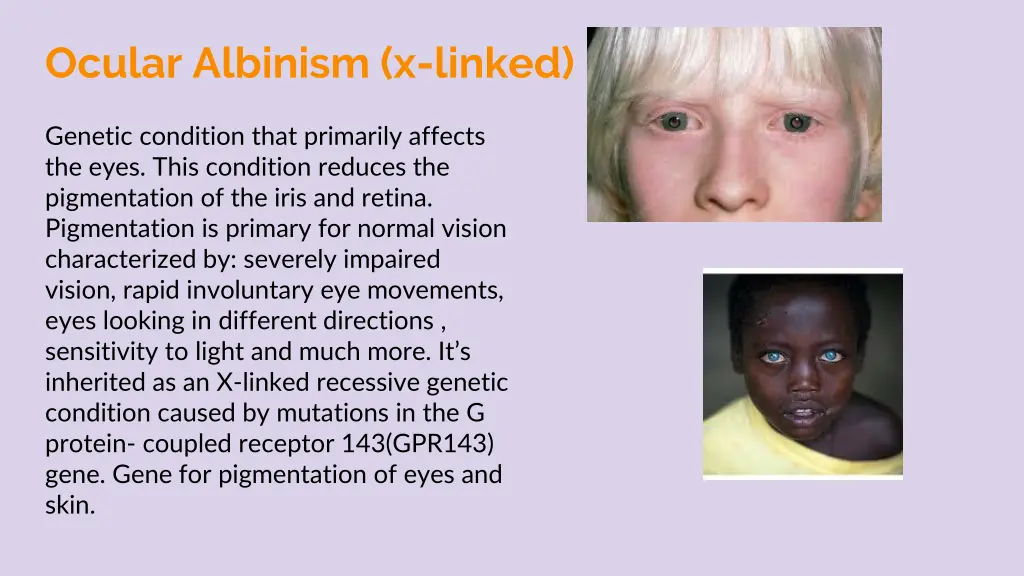 ocular albinism x linked