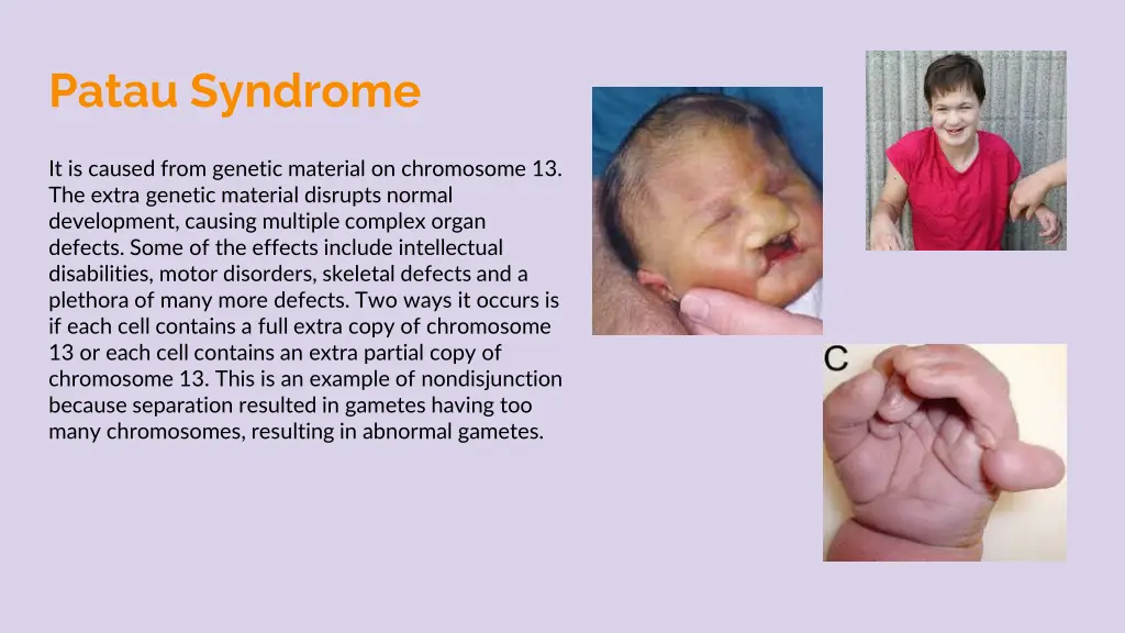 patau syndrome