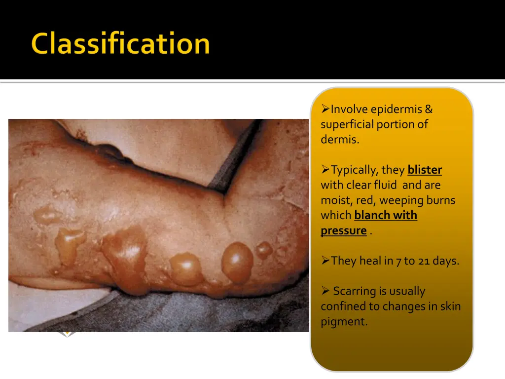 involve epidermis superficial portion of dermis