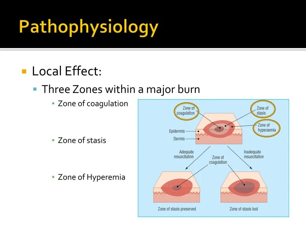 local effect three zones within a major burn zone