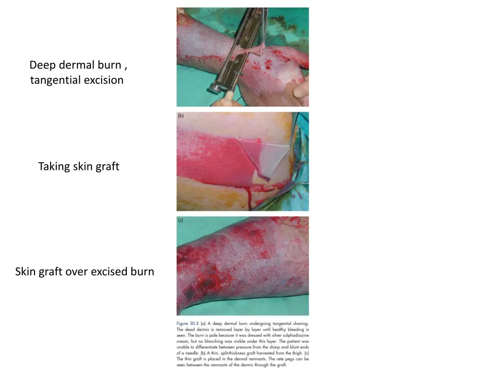 deep dermal burn tangential excision