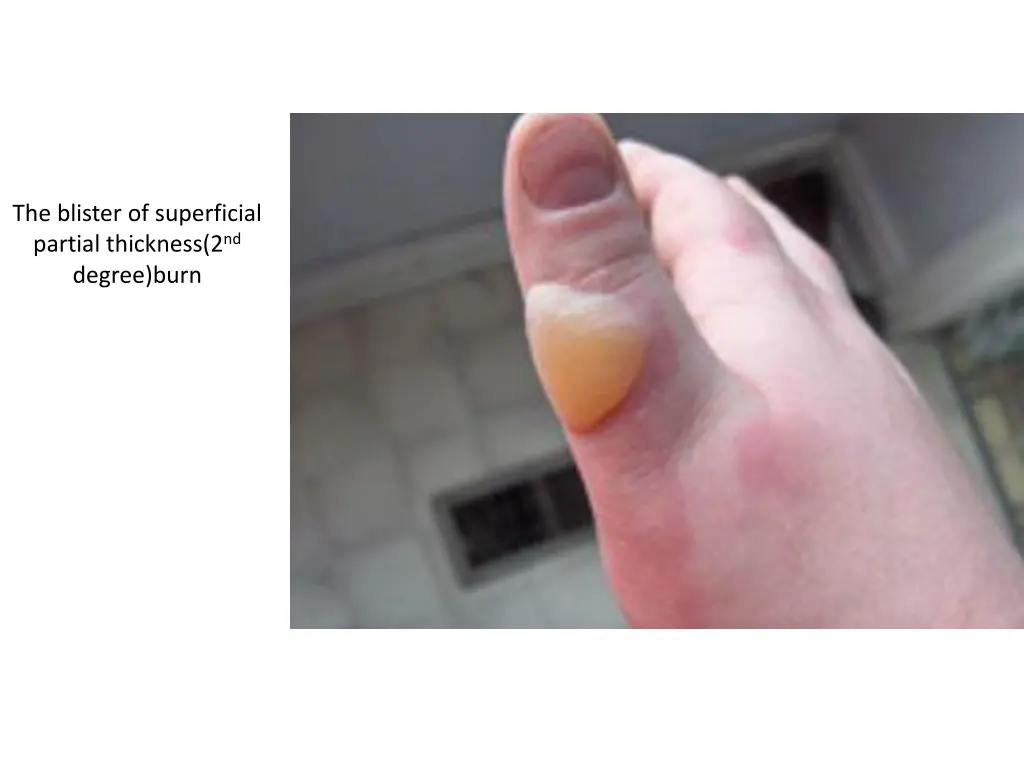 the blister of superficial partial thickness