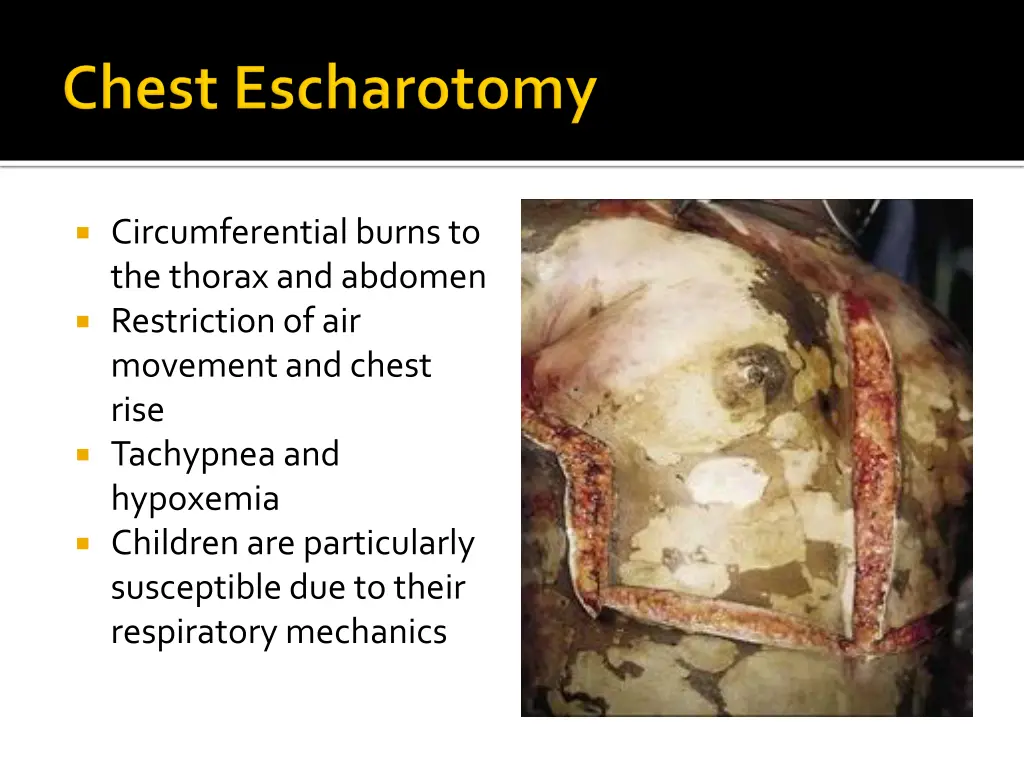 circumferential burns to the thorax and abdomen