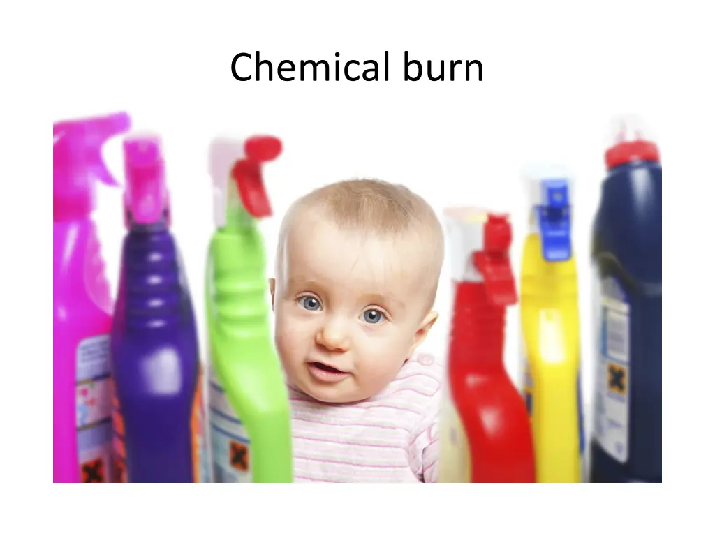 chemical burn