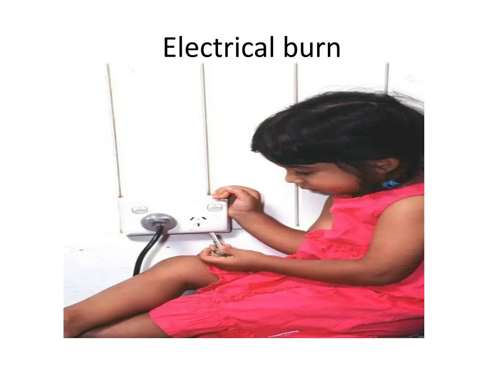 electrical burn