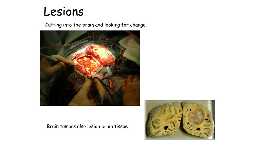 lesions cutting into the brain and looking