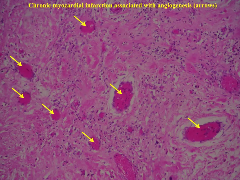 chronic myocardial infarction associated with