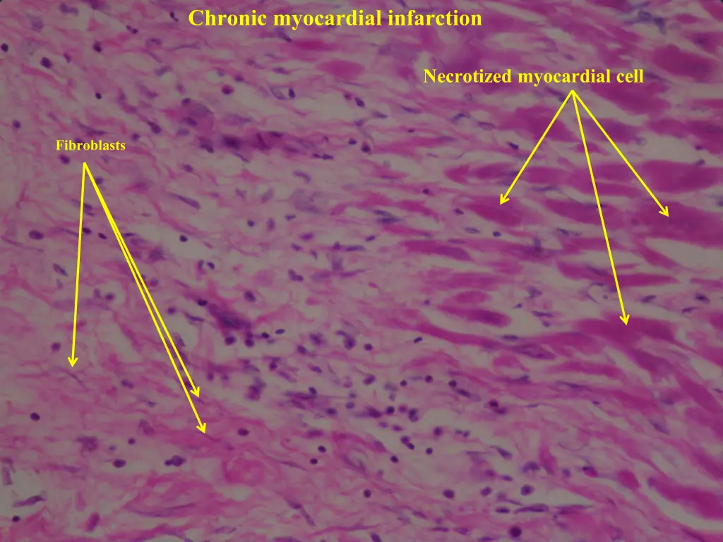 chronic myocardial infarction