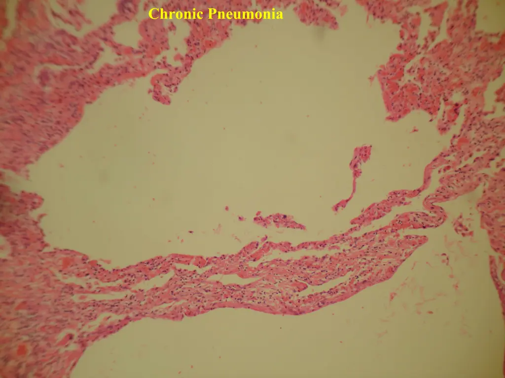 chronic pneumonia 1