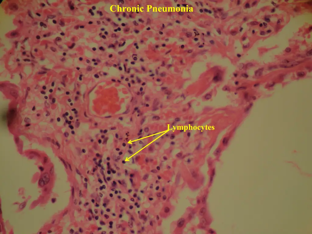 chronic pneumonia 2