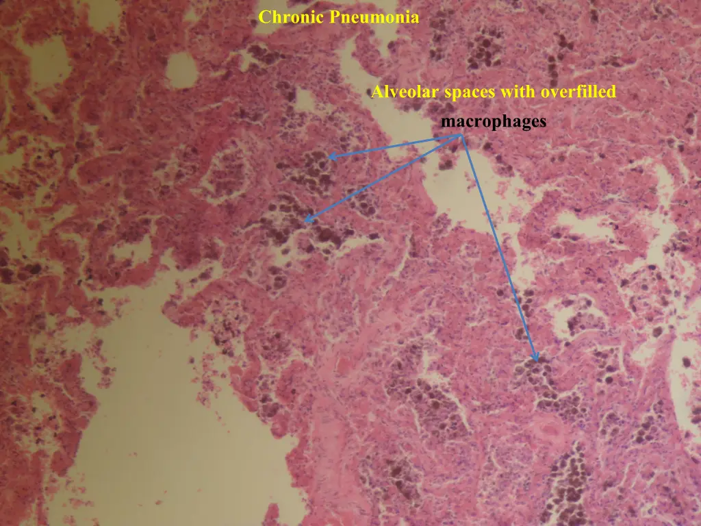 chronic pneumonia 4