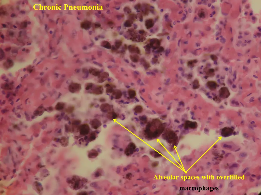 chronic pneumonia 5