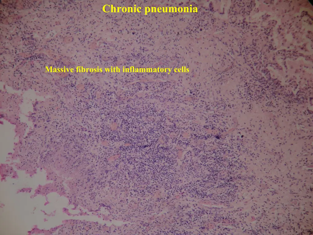 chronic pneumonia 6