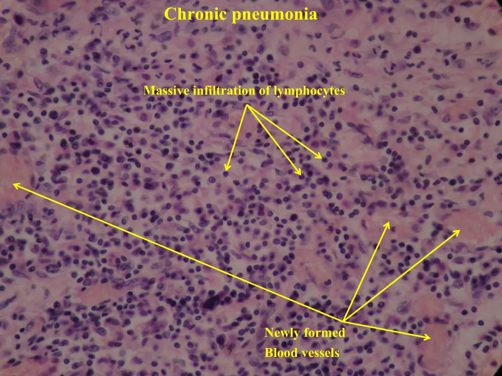 chronic pneumonia 7