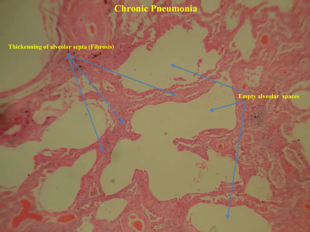 chronic pneumonia