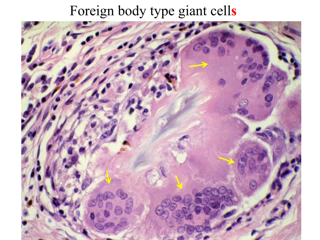 foreign body type giant cell s