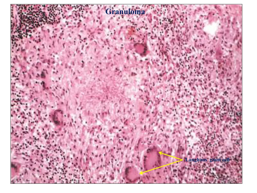 granuloma