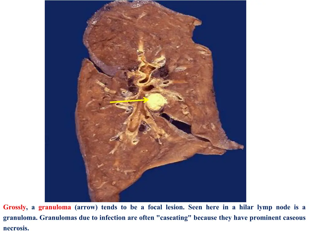 grossly a granuloma arrow tends to be a focal