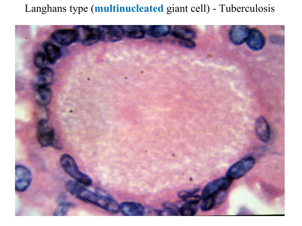 langhans type multinucleated giant cell