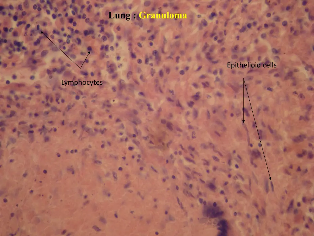 lung granuloma 1