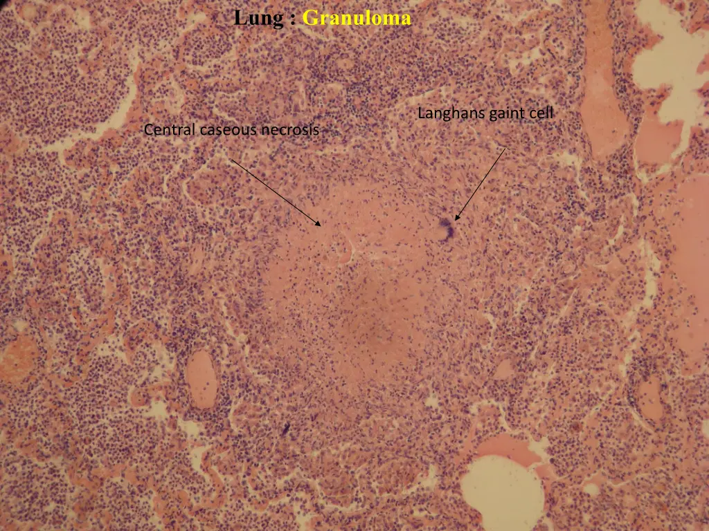 lung granuloma