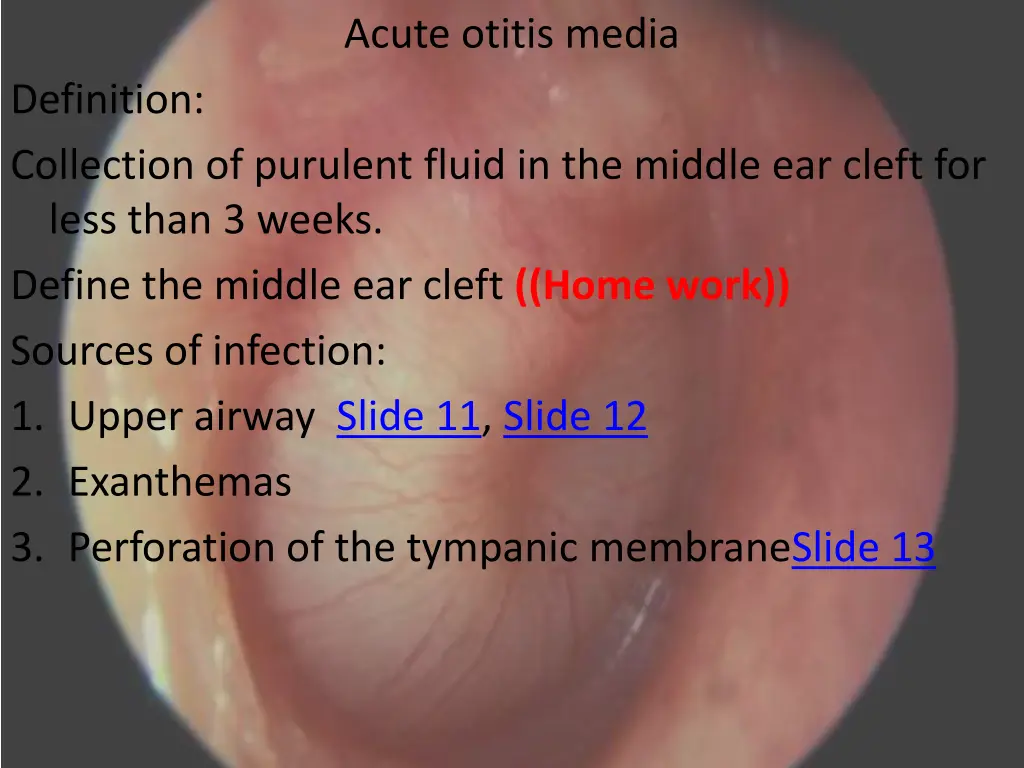 acute otitis media