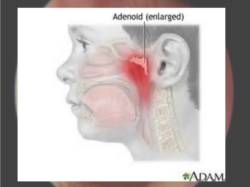 adenoid jpg