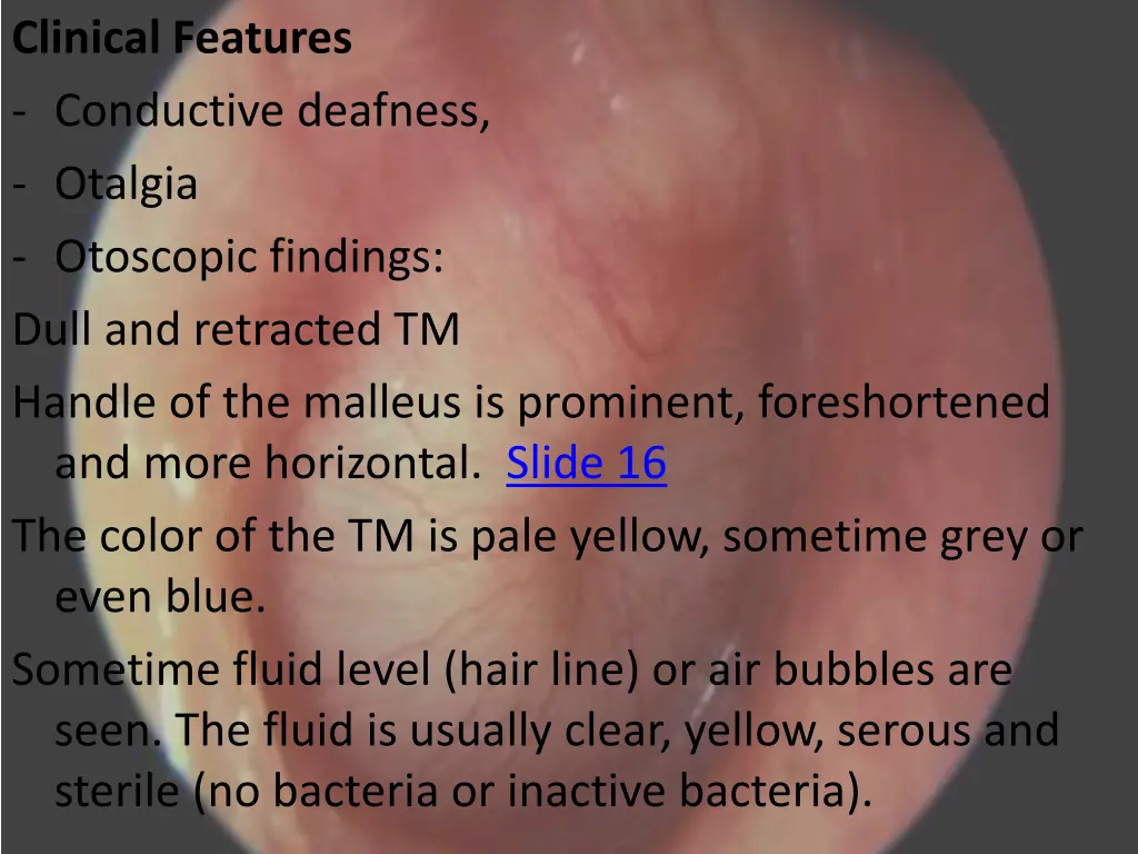 clinical features conductive deafness otalgia