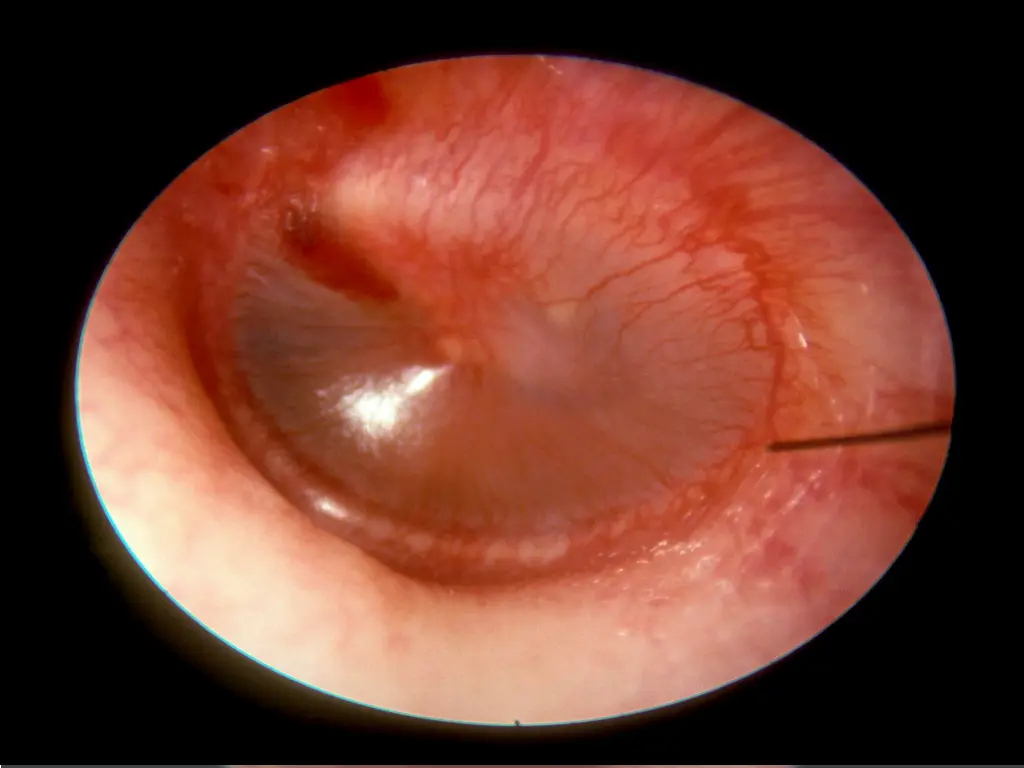 early aom dilatationd jpg