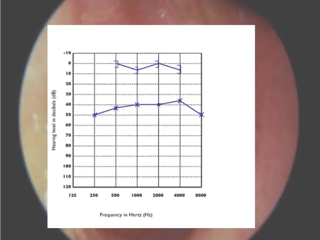 f fifth year ent instruments tests hearing