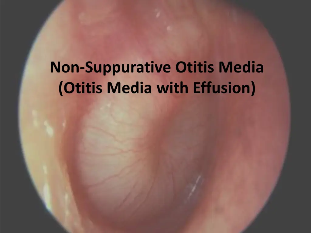 non suppurative otitis media otitis media with