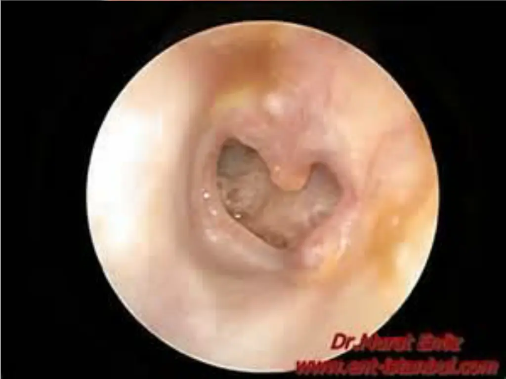 perforated eardrum jpg