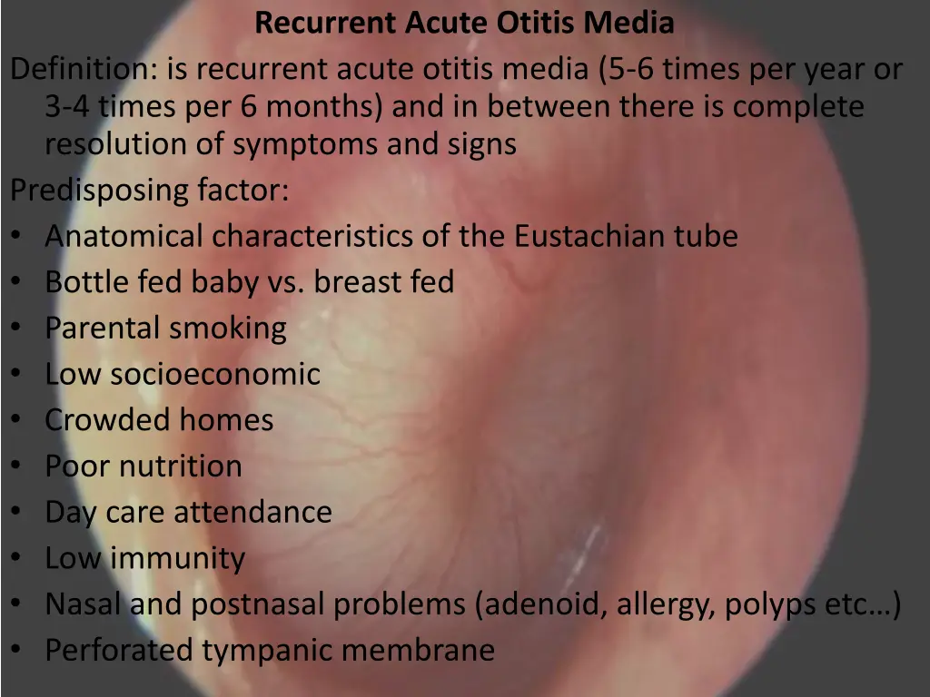 recurrent acute otitis media