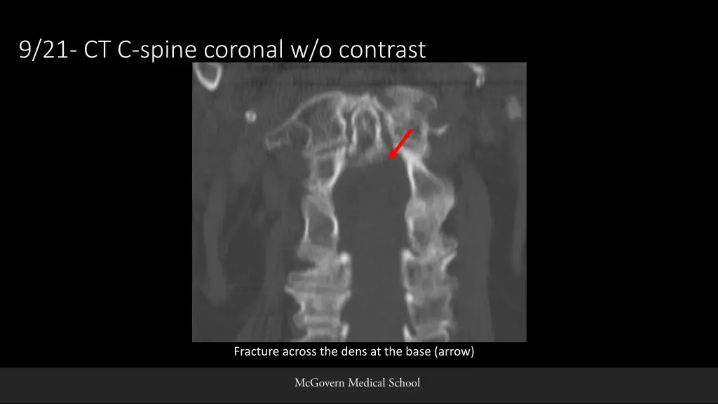 9 21 ct c spine coronal w o contrast