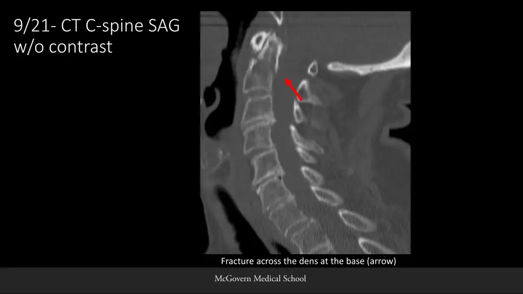 9 21 ct c spine sag w o contrast