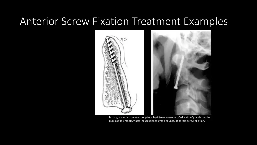 anterior screw fixation treatment examples