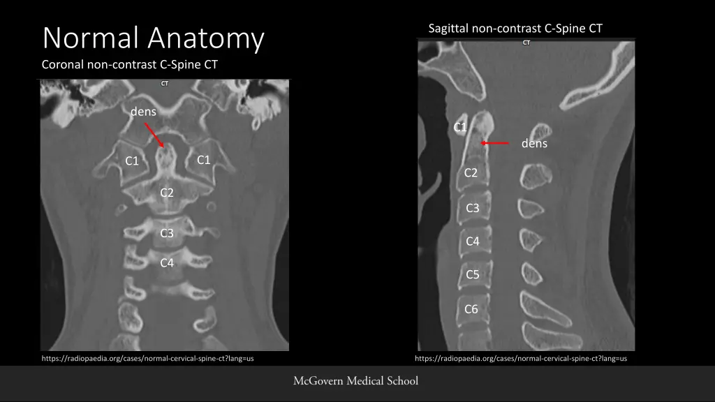 sagittal non contrast c spine ct